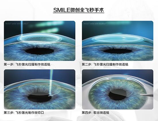 蔡司全飛秒、蔡司半飛秒近視手術與宇航飛秒的區(qū)別